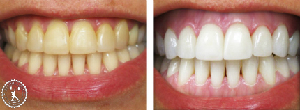 отзывы с фото до и после лазерного отбеливания зубов
