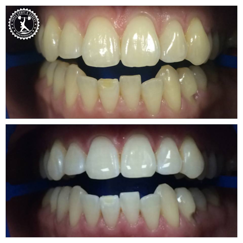 отбеливание зубоов – отзывы до и после этого с фото