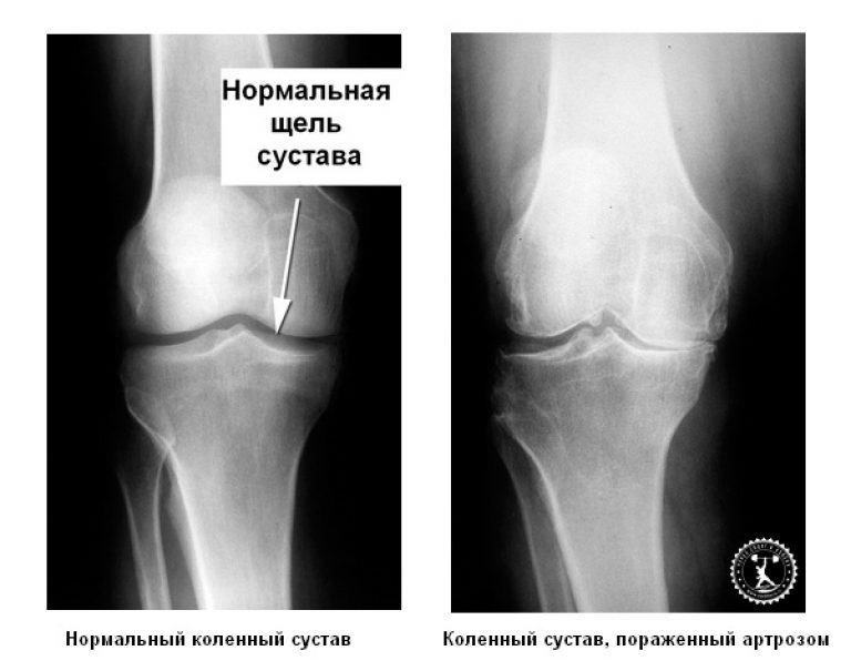 Артроз коленного сустава картинки