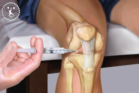 инъекции в коленный сустав при артрозе препараты