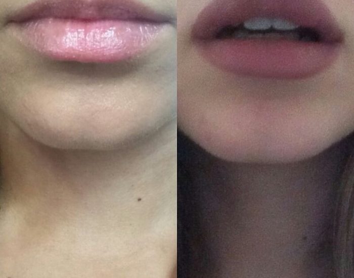 Фото до и после филлеров для губ