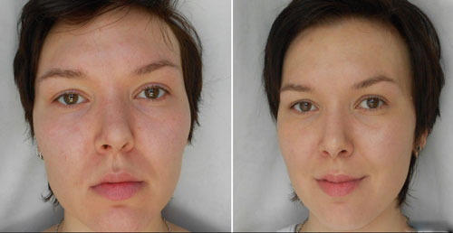 Отзывы про эффект биоревитализации лица с фото до и после