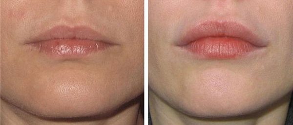 Фото до и после увеличения губ гиалуроновой кислотой 1 мл